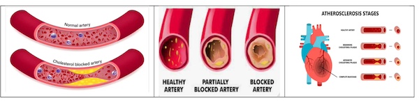 Know How To Clear Blocked Arteries 