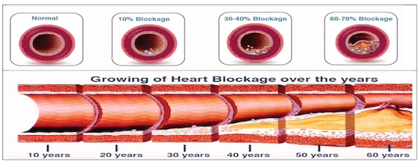 Know How To Detect Heart Disease 10 Years In Advance