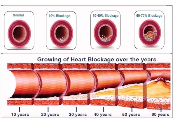 Know How To Detect Heart Disease 10 Years In Advance