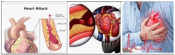 Know The Signs And Symptoms Of Heart Attacks